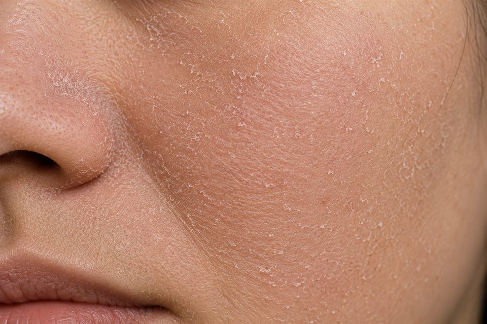 Dry Skin